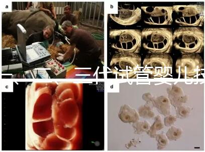 一、二、三代試管嬰兒技術的區別,看完你就知道了!