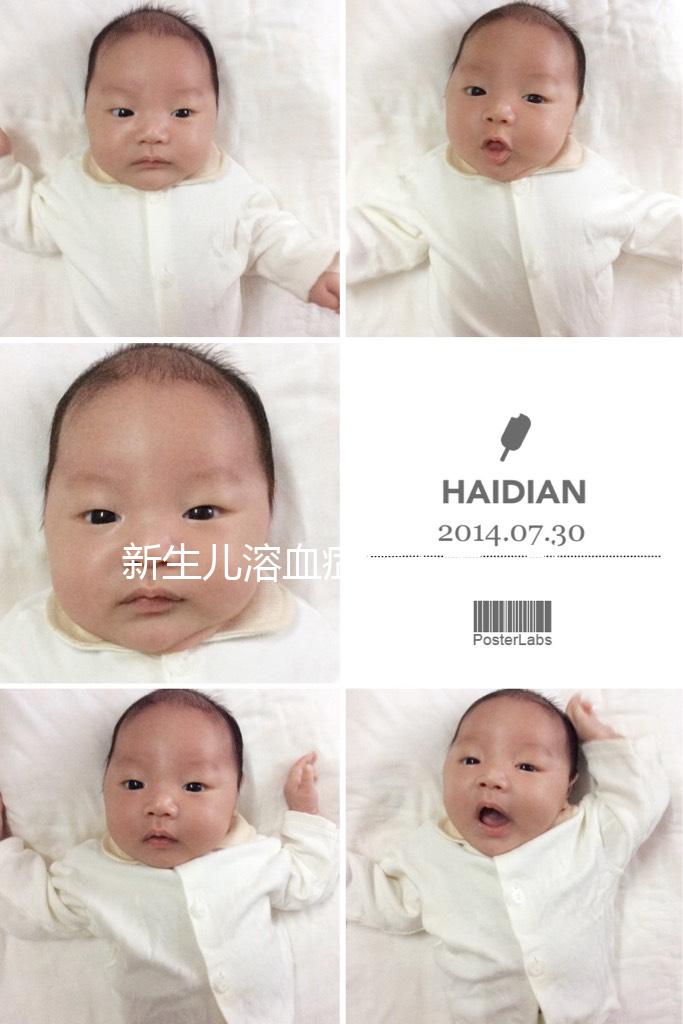 新生兒溶血癥危害大，引發膽紅素腦病可致神經后遺癥