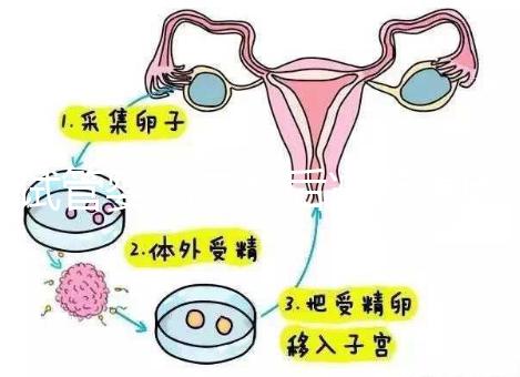 試管嬰兒二超后減藥原因已找到，對(duì)胎兒沒(méi)影響別瞎擔(dān)心
