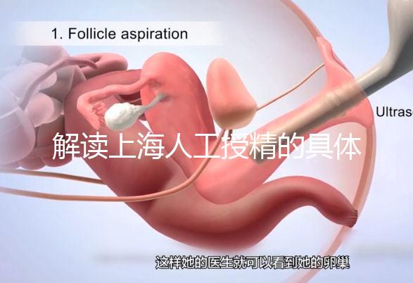 解讀上海人工授精的具體過程，會不會痛看醫生怎么說？